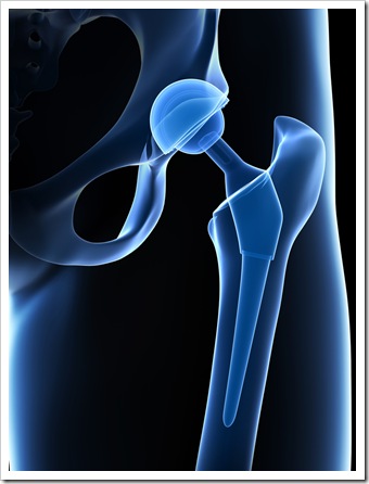 Back Pain Billings MT Joint Replacement