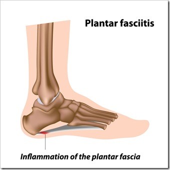 Foot Pain Billings MT Plantar Fasciitis